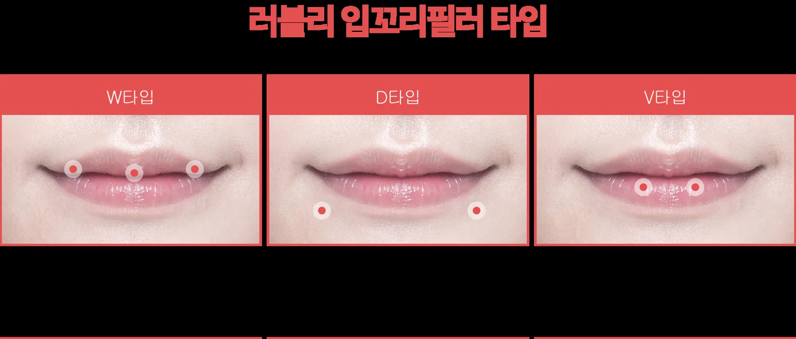 Lip Corner Filler