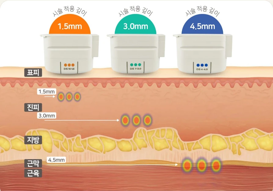 3 jenis tip khusus Ulthera Prime dan ilustrasi kedalaman lapisan kulit (1.5·3.0·4.5mm)