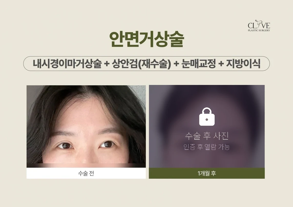 リフティング 内視鏡額リフト + 上眼瞼の再手術 + 目つき矯正 ビフォーアフター