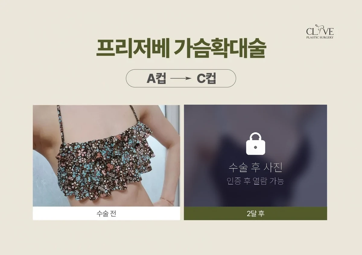 가슴성형 프리저베 가슴성형 전후