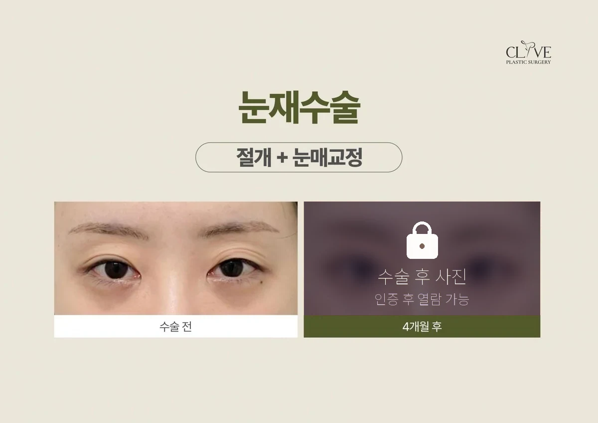 눈성형 절개 재수술 + 눈매교정 전후
