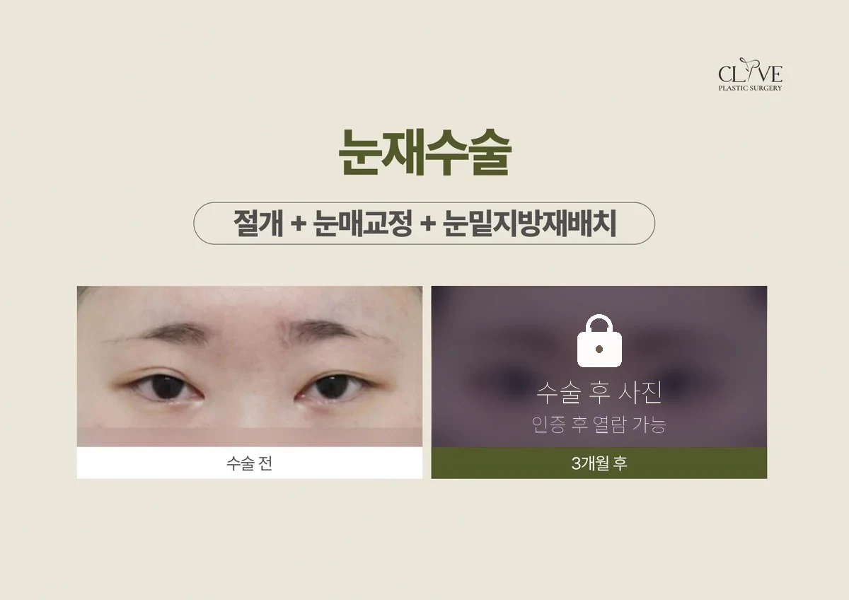 눈성형 절개 재수술 + 눈매교정 + 눈밑지방재배치 전후