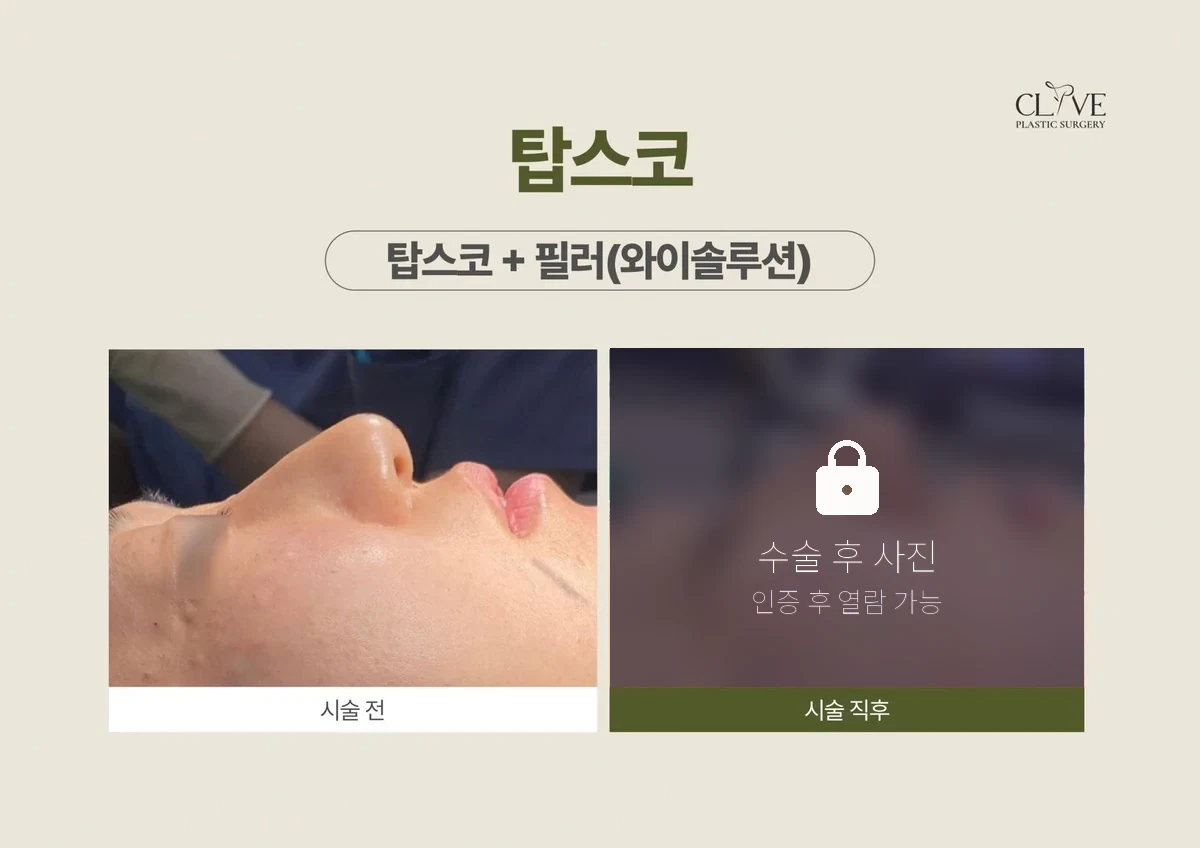 쁘띠시술 탑스코 전후