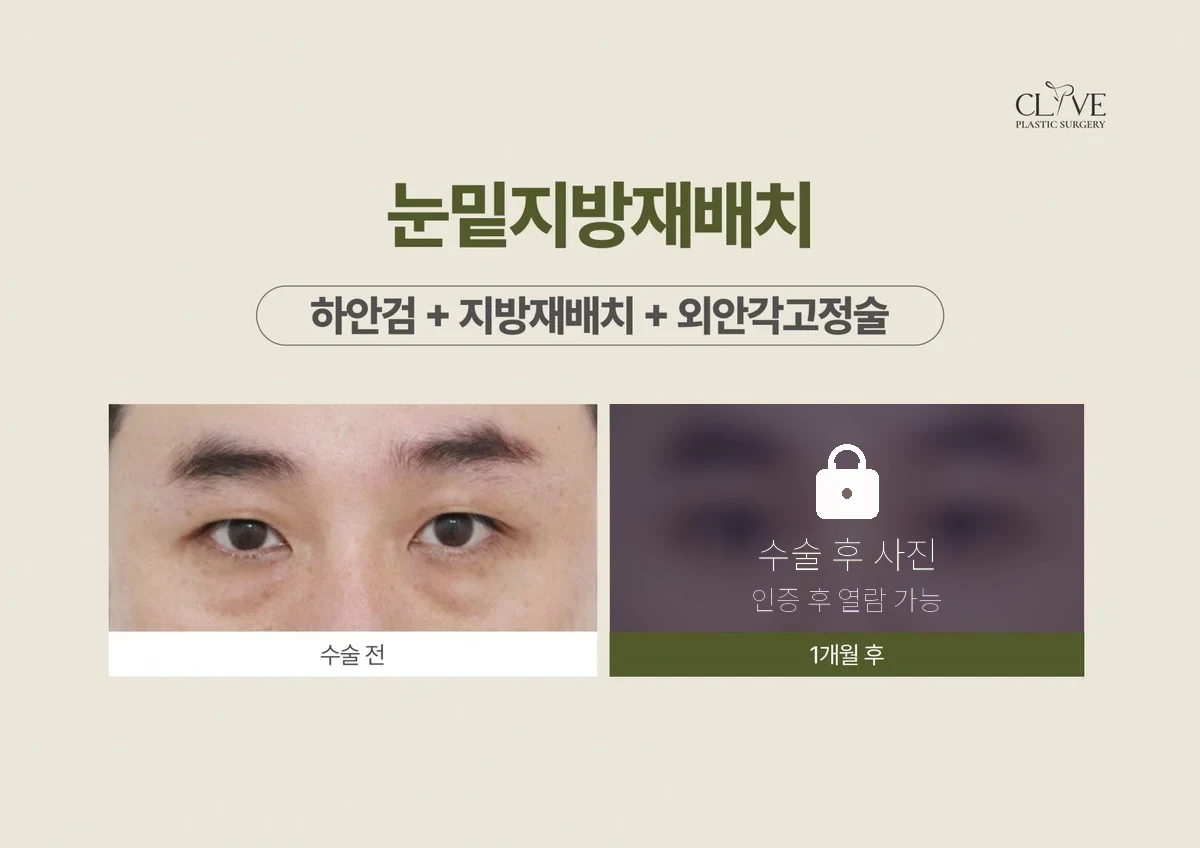 눈성형 하안검 + 지방재배치 + 외안각고정술 전후