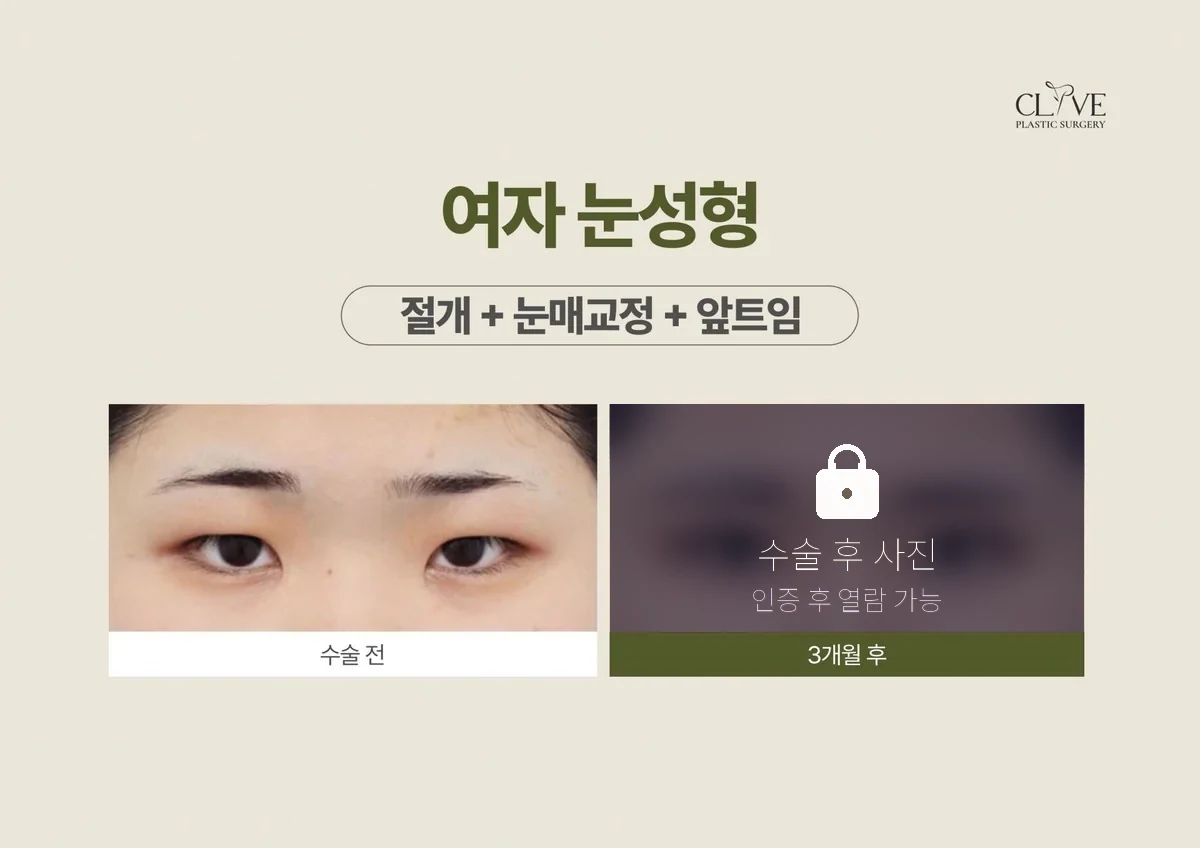 눈성형 절개 + 눈매교정 + 앞트임 전후