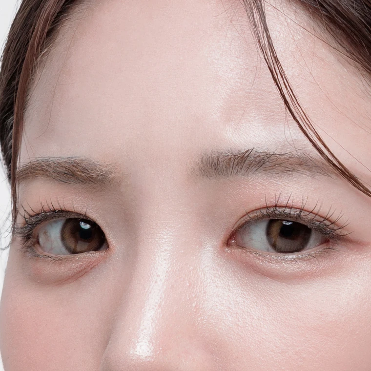 Khi đã mở góc mắt nhưng không đạt hiệu quả mong muốn
