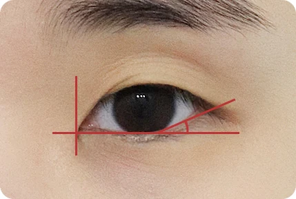 Góc đuôi mắt trước phẫu thuật