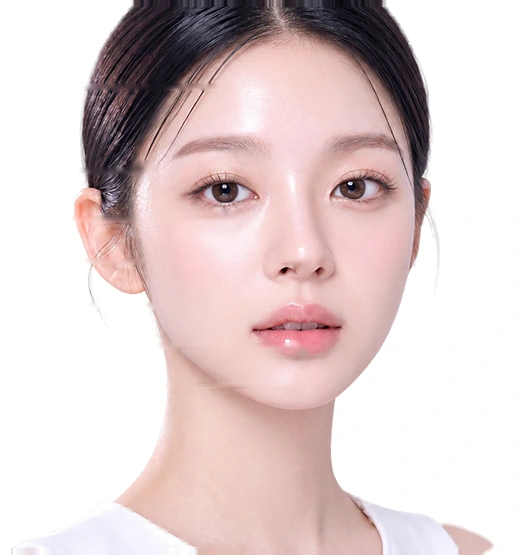 Gương mặt đánh dấu vùng tiêm filler