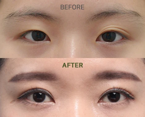 Natural Adhesion Double Eyelid Surgery Before & After