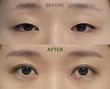 Incisional Double Eyelid Surgery Before & After