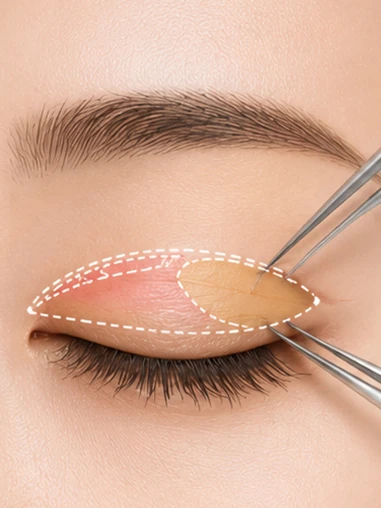 Illustration for Choosing the Right Surgical Method for Your Eye Condition
