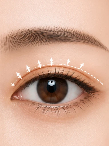 Diagram illustrating the design of the double eyelid line flow