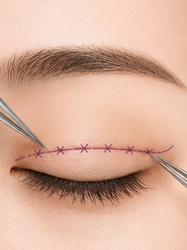 Illustration: Suturing the Incision Site for Secure Fixation