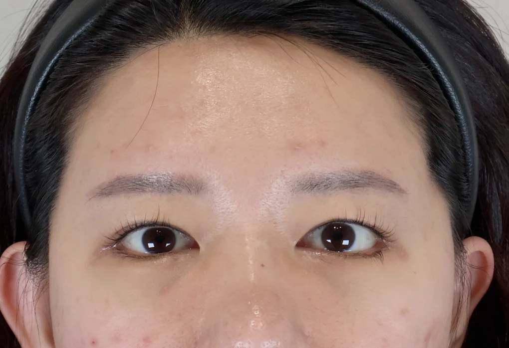 內視鏡額部拉提術 手術前