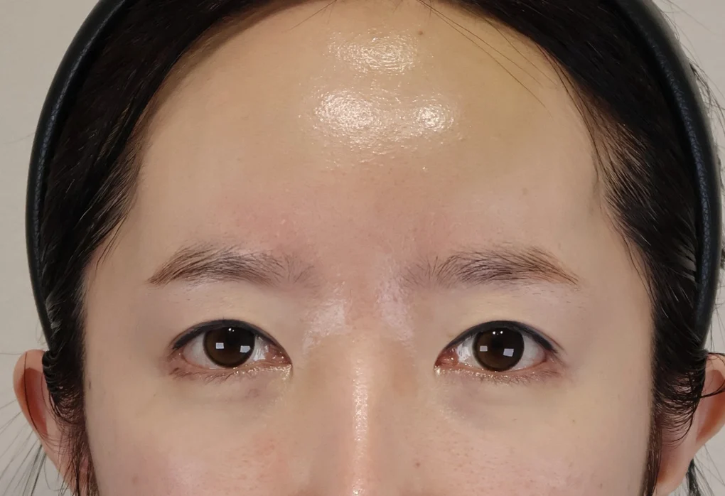 內視鏡額部拉提術 手術前