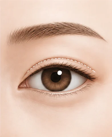 إعادة تصميم الخط والخياطة