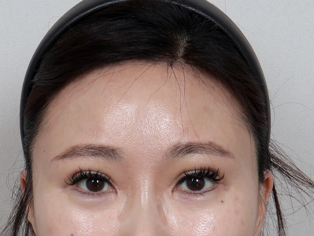 額頭縮小術 術後2個月
