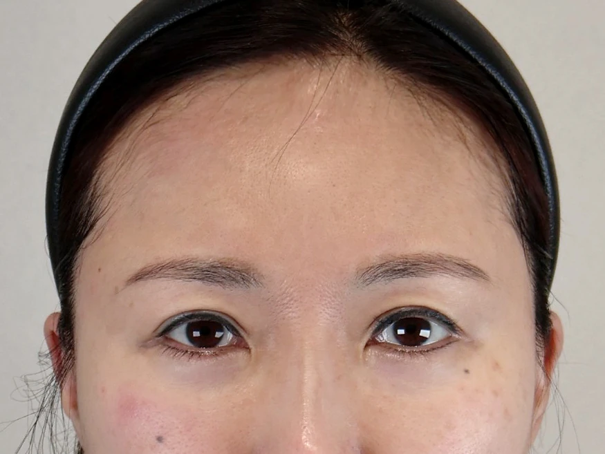 額頭縮小術 術前