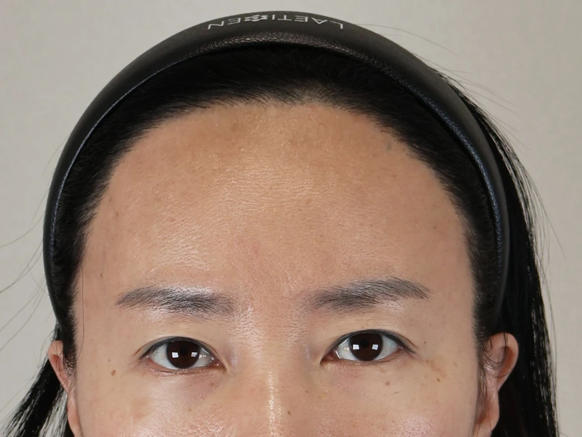 額頭縮小術 術前