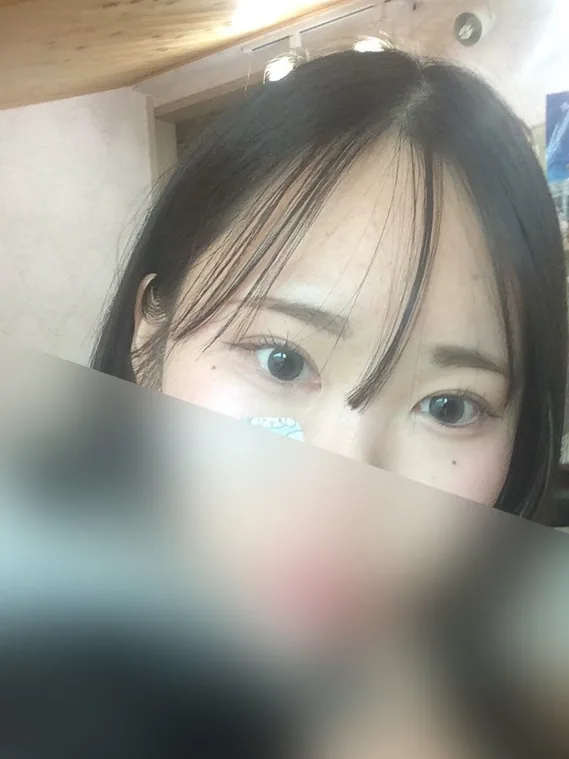 눈재수술 후기