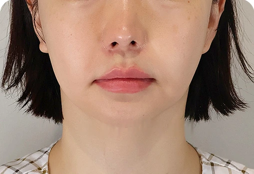 ก่อนผ่าตัดลิฟติ้งบางส่วนใบหน้าส่วนล่าง