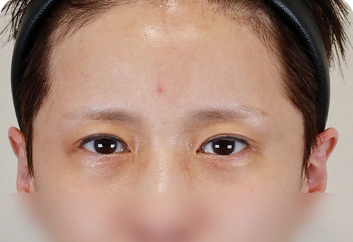 ลิฟติ้งบางส่วนใบหน้าส่วนบน — 1 เดือนหลังผ่าตัด