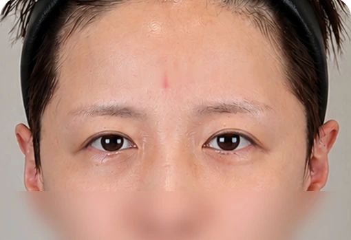 ก่อนผ่าตัดลิฟติ้งบางส่วนใบหน้าส่วนบน