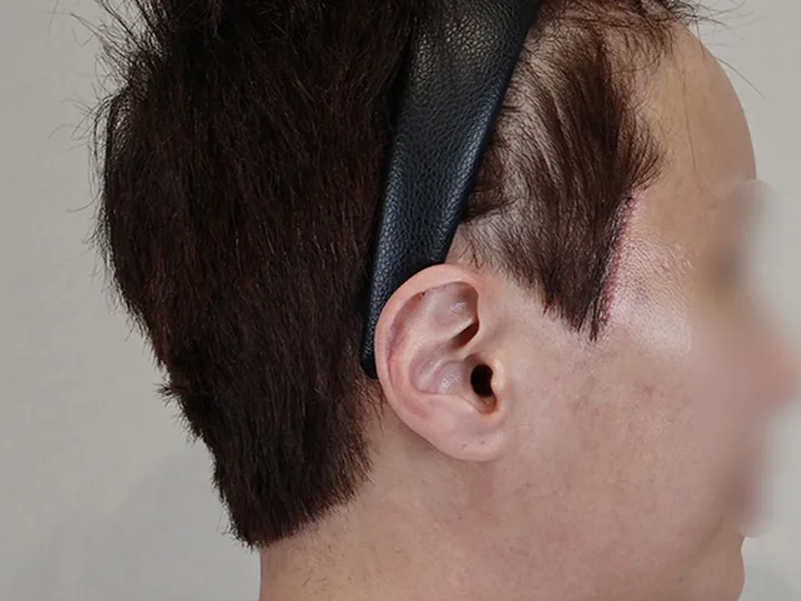 บริเวณแผลลิฟติ้งบางส่วนใบหน้าส่วนบน — 3 วันหลังผ่าตัด