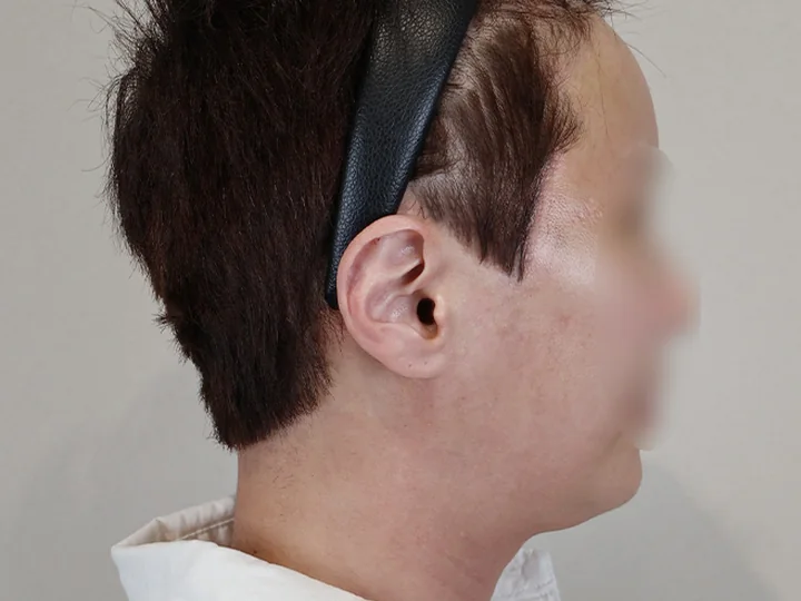 บริเวณแผลลิฟติ้งบางส่วนใบหน้าส่วนบน — 1 เดือนหลังผ่าตัด