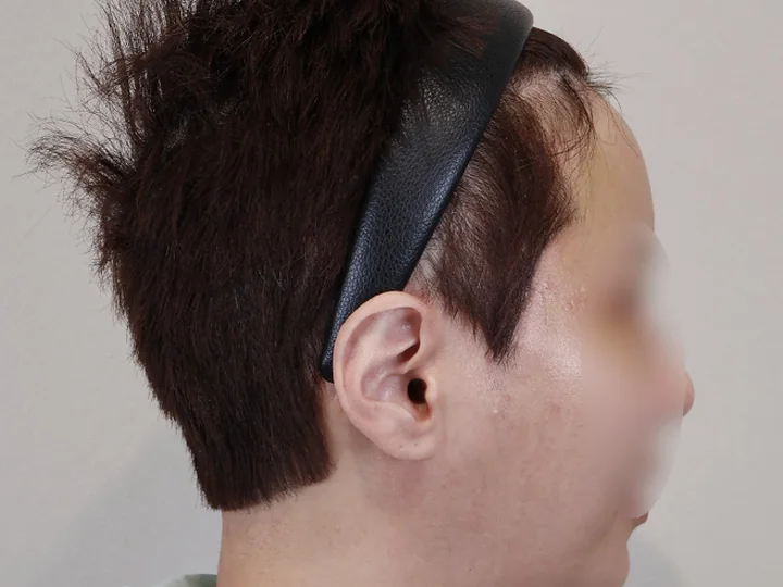 บริเวณแผลลิฟติ้งบางส่วนใบหน้าส่วนบน — 6 เดือนหลังผ่าตัด