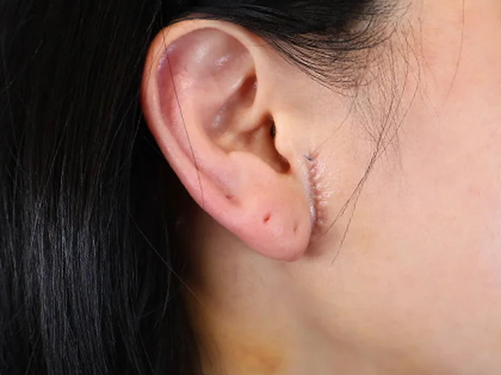 บริเวณแผลลิฟติ้งบางส่วนใบหน้าส่วนล่าง — 7 วันหลังผ่าตัด