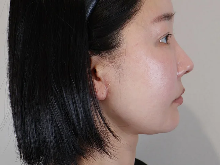 บริเวณแผลลิฟติ้งบางส่วนใบหน้าส่วนล่าง — 1 เดือนหลังผ่าตัด