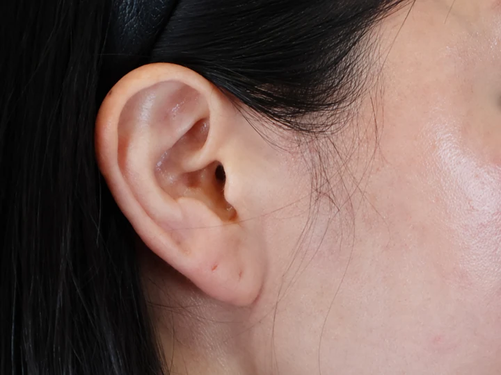 บริเวณแผลลิฟติ้งบางส่วนใบหน้าส่วนล่าง — 5 เดือนหลังผ่าตัด