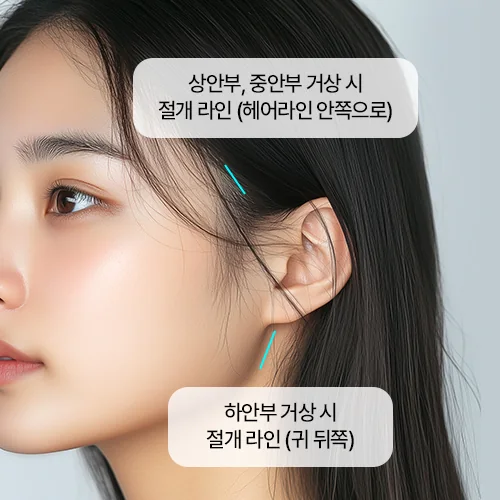 แนวกรีด — ใบหน้าส่วนบน·ส่วนกลางอยู่ด้านในแนวไรผม ส่วนล่างอยู่หลังใบหู