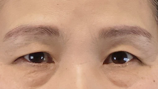 上・下眼瞼 術前
