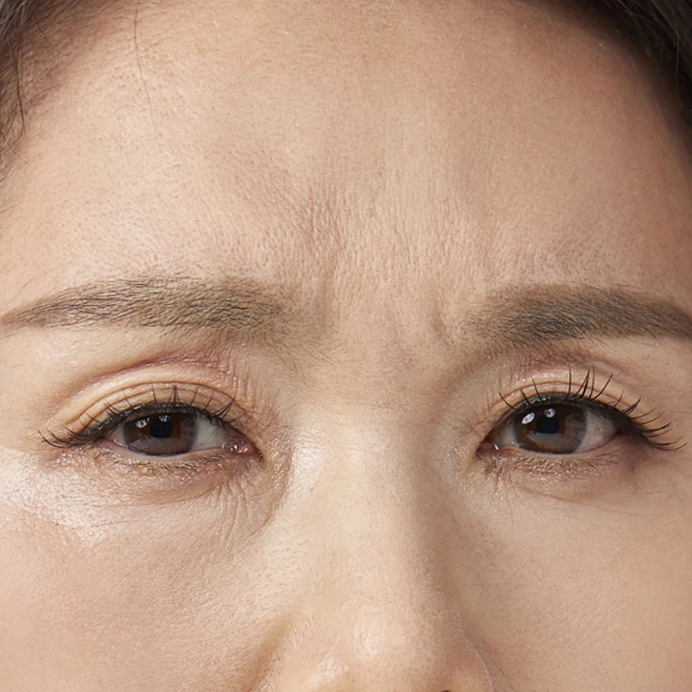 たるんだ上まぶたによって目もとが重く疲れて見える場合