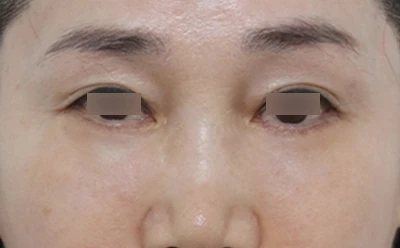 下眼瞼とスープリフト 術後3か月