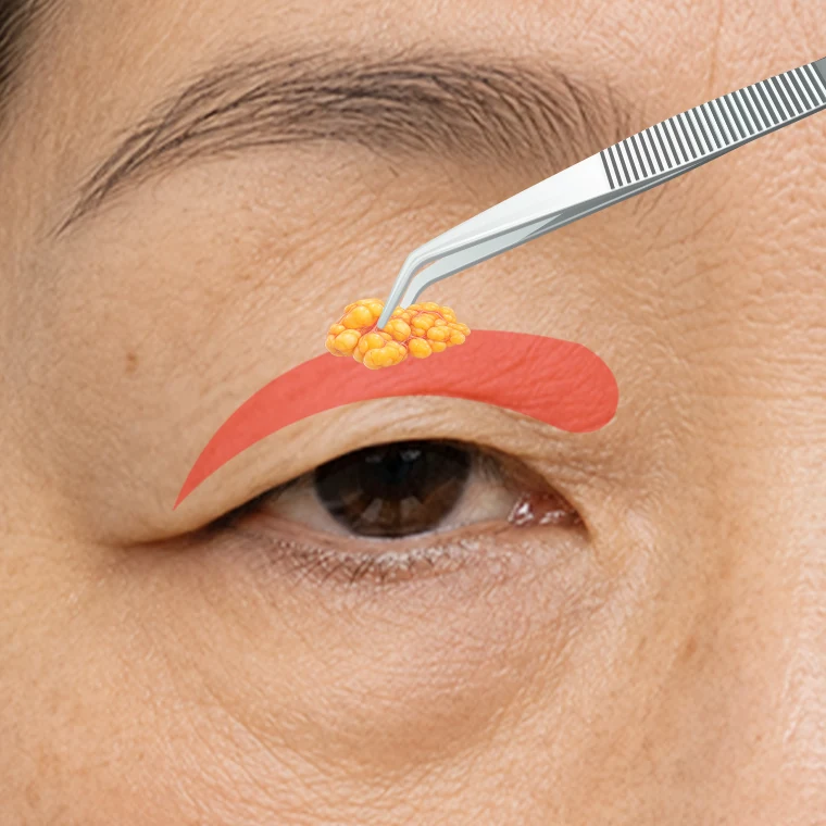 二重ラインで切開し、たるんだ眼輪筋を矯正して皮膚、脂肪などを除去