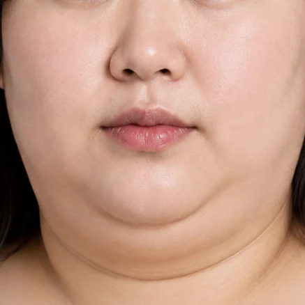 Đường nét khuôn mặt trông nặng nề do nọng cằm và mỡ quanh đường viền hàm