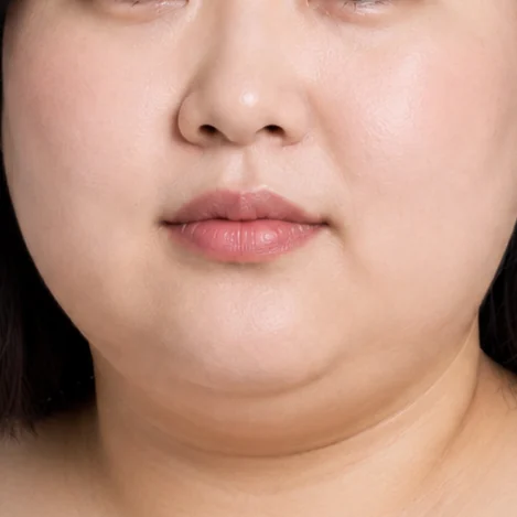 Mỡ phân bố đều trên mặt khiến gương mặt trông tròn