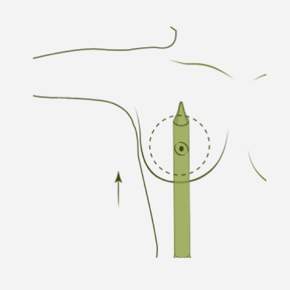 Incision and Tunnel Formation Diagram