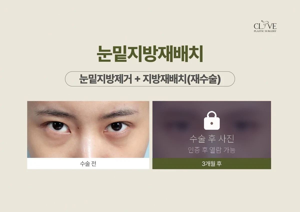 ศัลยกรรมตา — ผ่าตัดแก้ไขกำจัดไขมันใต้ตา + จัดเรียงใหม่ ก่อนและหลัง