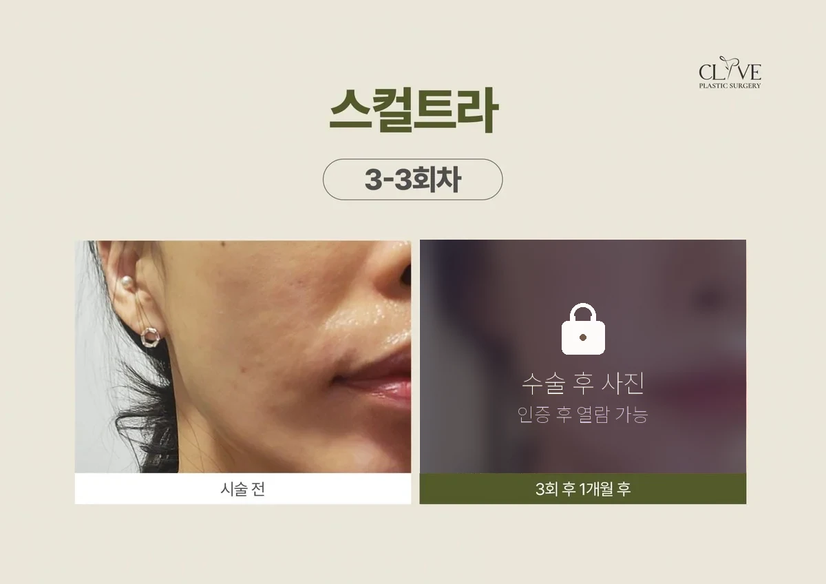 หัตถการฉีด — Sculptra ก่อนและหลัง