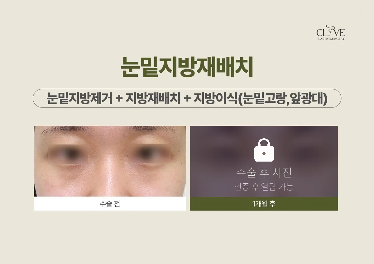 ศัลยกรรมตา — กำจัดไขมันใต้ตา + จัดเรียงใหม่ + ฉีดไขมัน ก่อนและหลัง