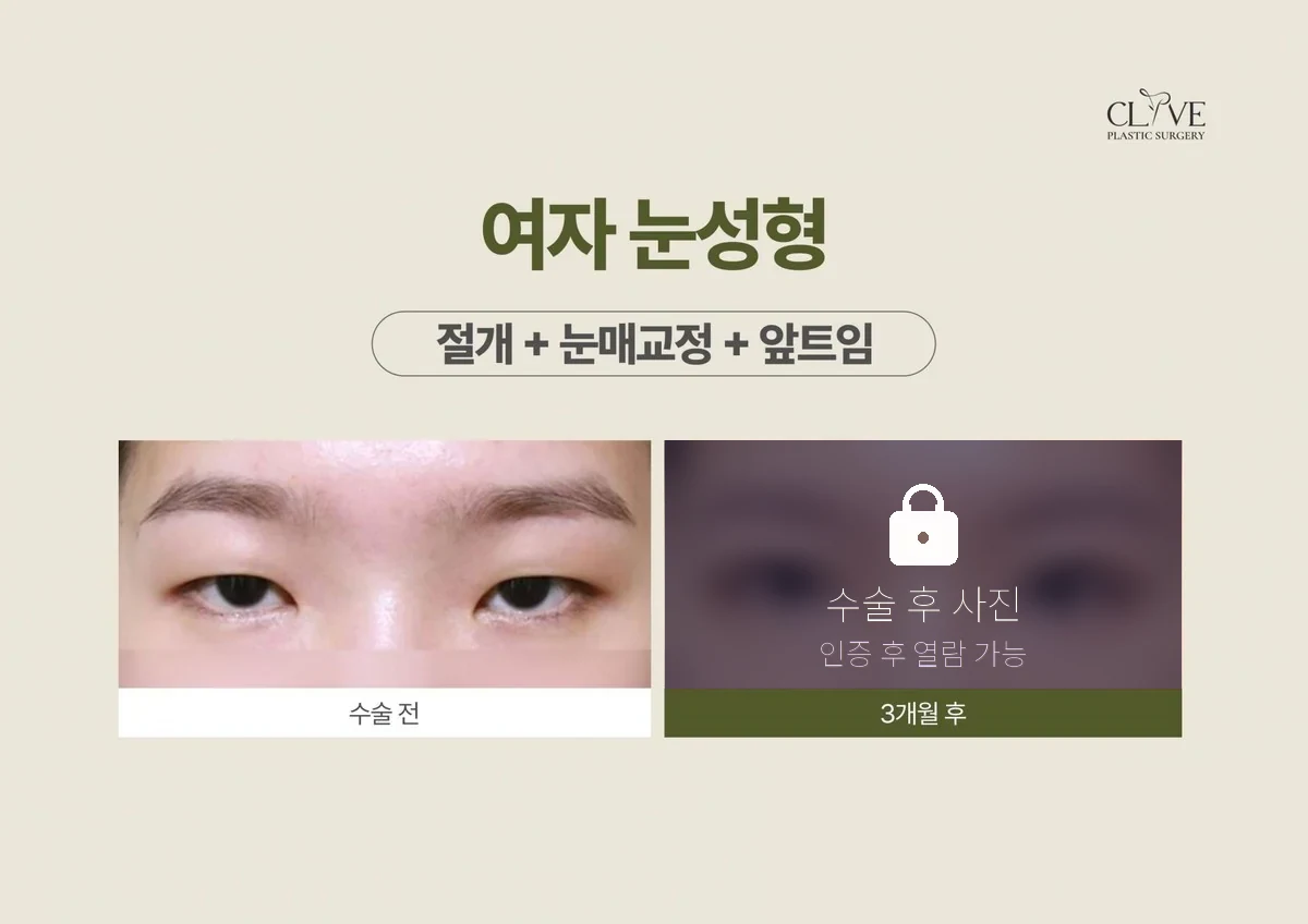 ศัลยกรรมตา — กรีดตาสองชั้น+แก้ไขกล้ามเนื้อตา+เปิดหัวตา ก่อนและหลัง