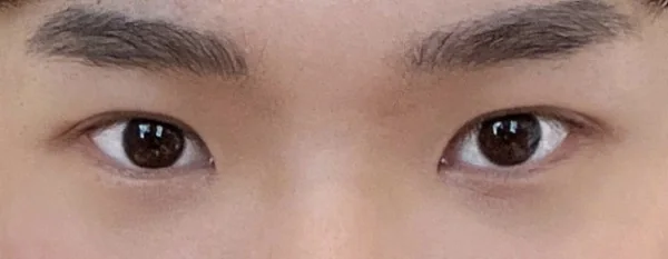 รีวิวหลังผ่าตัด