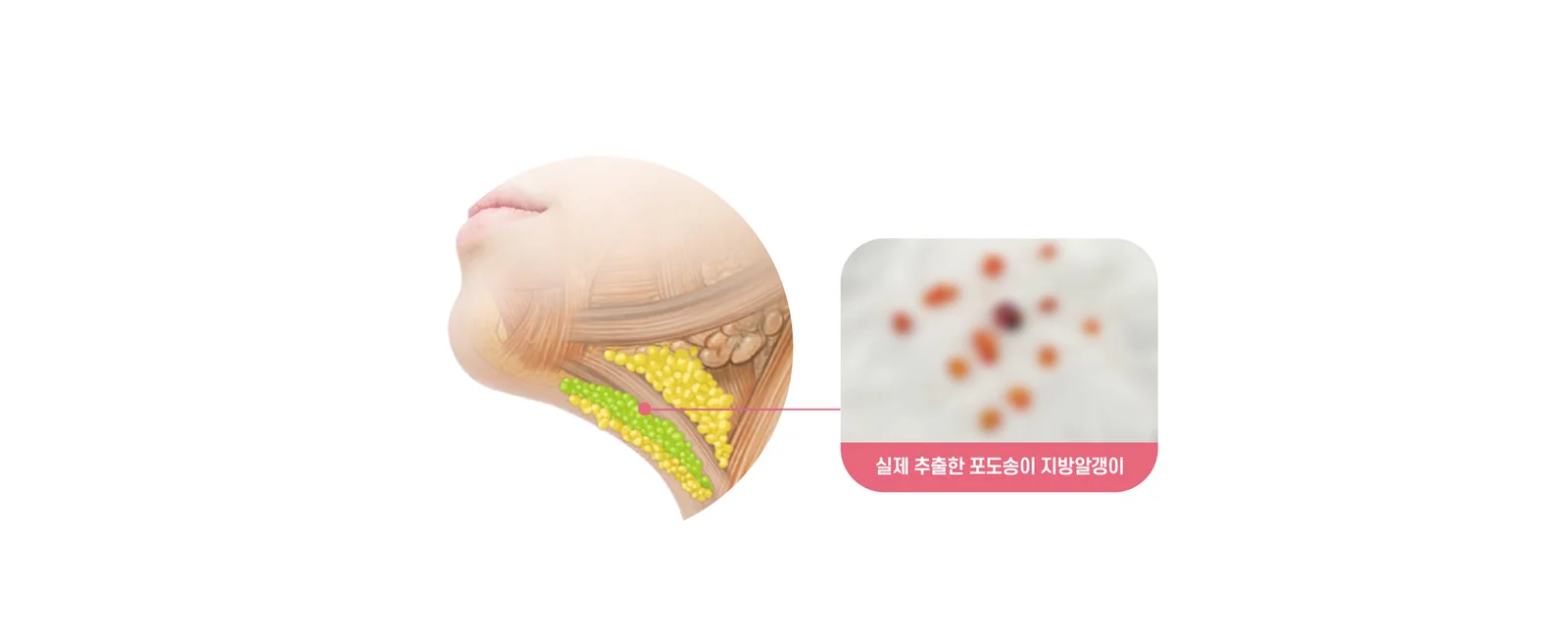 Loại bỏ các hạt mỡ bám vào lớp cơ — hạt mỡ dạng chùm nho được lấy ra trên thực tế