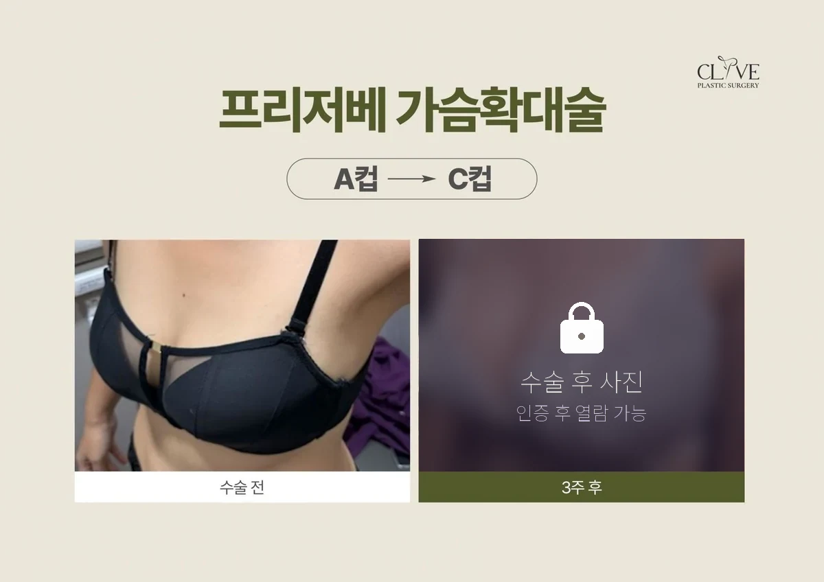 隆乳 Preserve 隆乳 術前術後